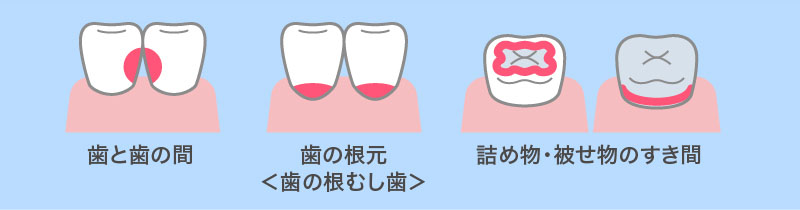 歯と歯の間、歯の根元、詰め物・被せ物のすき間