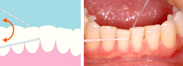 歯と歯の間にデンタルフロスを使用する。