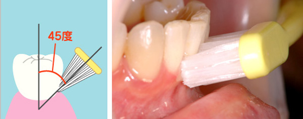 歯の表側の磨き方は、歯と歯肉の境に歯ブラシの毛先を45度になるように当て、弱い力で細かく振動する。