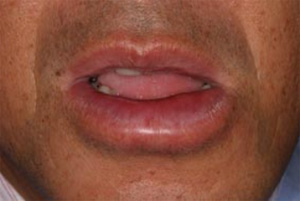 下唇の血管神経性浮腫（クインケ浮腫）