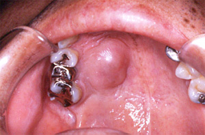 粘膜下の唾液腺腫瘍
