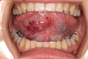 右側舌背部に見られる血管腫