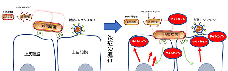 コロナ 血管 炎症