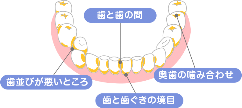 歯垢は、歯の表面や歯と歯の間などに付着する