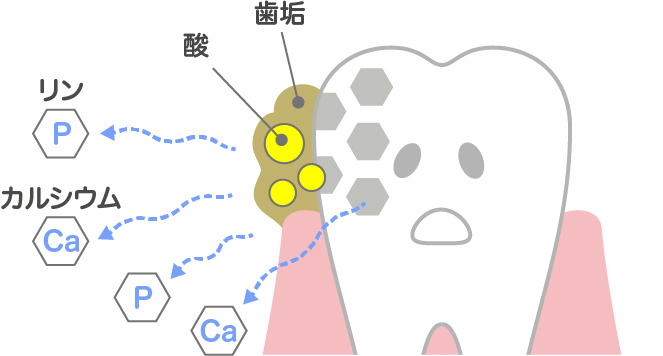 細菌がつくる「酸」によって歯が溶かされる