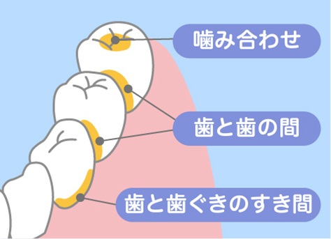 みがき残しをしやすい部分