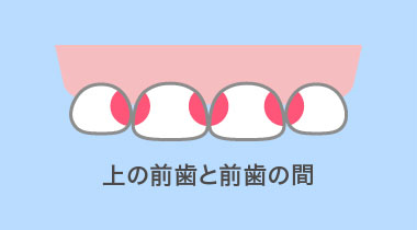 上の前歯と前歯の間