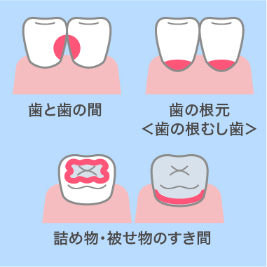 歯と歯の間、歯の根元、詰め物・被せ物のすき間