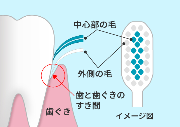 たるみをもたせた高強度繊維フロスが約120本