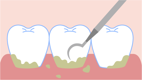 ブラッシングでは落とせない「歯石」を除去 イメージ