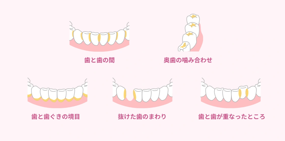 歯と歯の間、奥歯の噛み合わせ、歯と歯ぐきの境目、抜けた歯のまわり、歯と歯が重なったところ