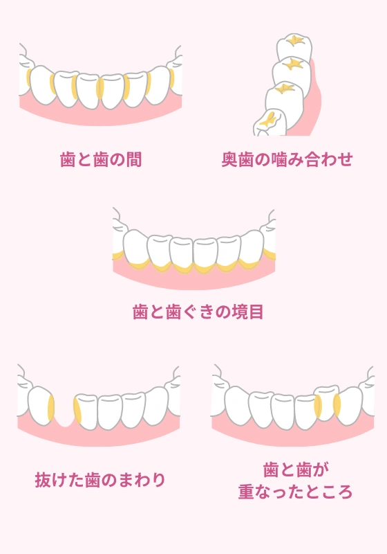 歯と歯の間、奥歯の噛み合わせ、歯と歯ぐきの境目、抜けた歯のまわり、歯と歯が重なったところ