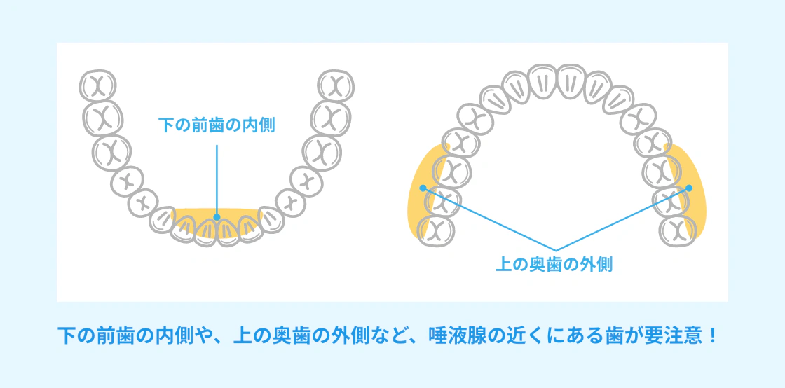 下の前歯の内側や、上の奥歯の外側など、唾液腺の近くにある歯が要注意！