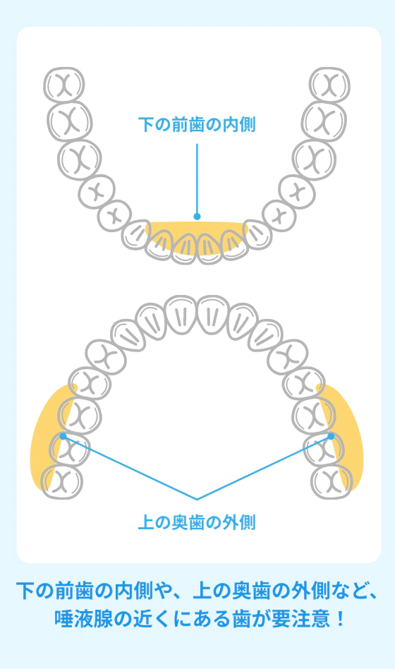 下の前歯の内側や、上の奥歯の外側など、唾液腺の近くにある歯が要注意！