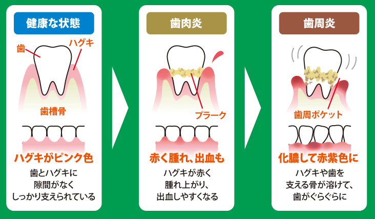 健康な状態｜歯肉炎｜歯周炎