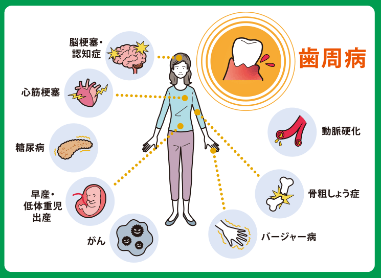 歯周病が体の病気の要因に！