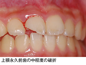 歯の外傷 歯とお口のことなら何でもわかる テーマパーク80