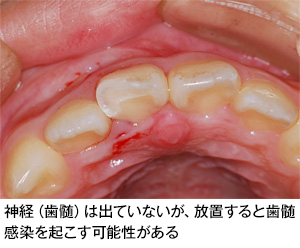 歯の外傷 歯とお口のことなら何でもわかる テーマパーク80