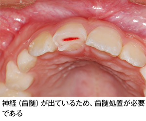 歯の外傷 歯とお口のことなら何でもわかる テーマパーク80