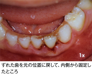 歯の外傷 歯とお口のことなら何でもわかる テーマパーク80