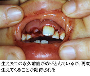 歯の外傷 歯とお口のことなら何でもわかる テーマパーク80