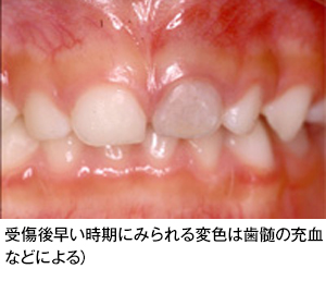 歯の外傷 歯とお口のことなら何でもわかる テーマパーク80