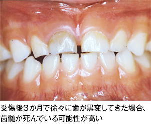 歯の外傷 歯とお口のことなら何でもわかる テーマパーク80