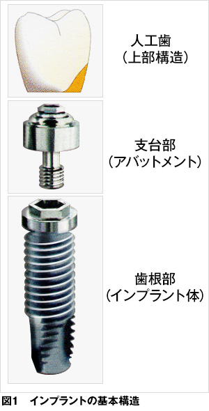 【ブログ】インプラントとは何ですか？