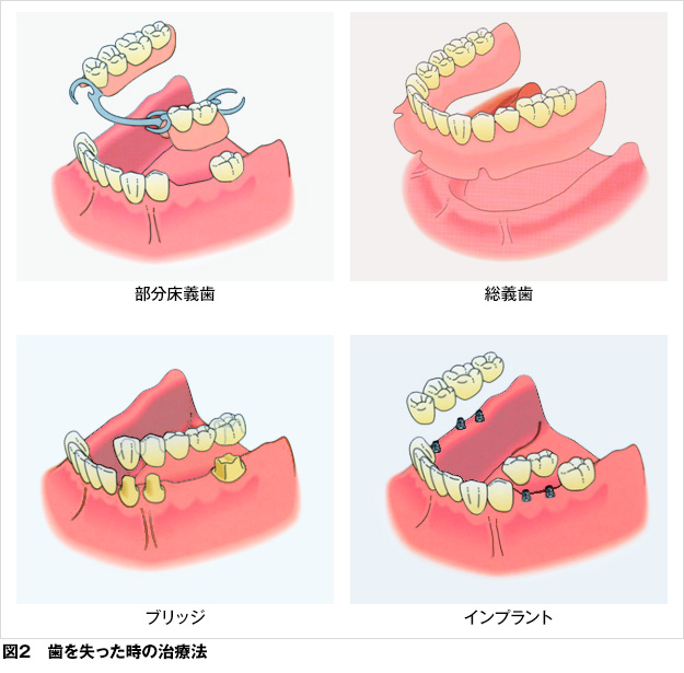 歯科用インプラント