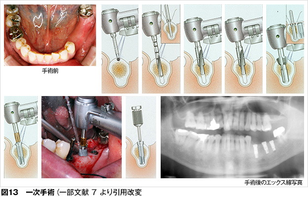 インプラント 歯とお口のことなら何でもわかる テーマパーク8020