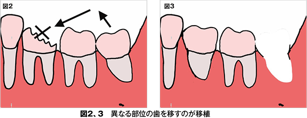 歯牙再植 - 歯とお口のことなら何でもわかる テーマパーク8020