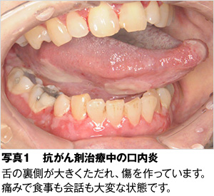 がん治療と口のケア がん治療を乗り越えるために 歯とお口のことなら何でもわかる テーマパーク8020