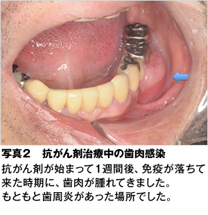 薬 市販 に 歯茎 の 腫れ 効く