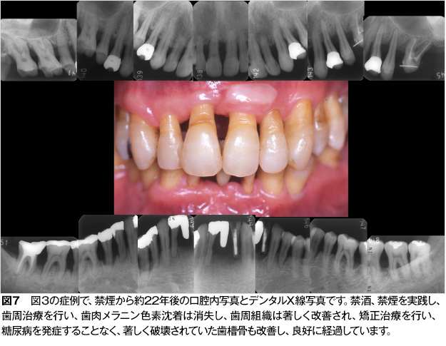 勃起不全の新しいブレークスルー