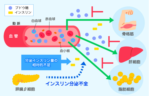 糖尿病ってどんな病気 歯周病と糖尿病 歯とお口のことなら何でもわかる テーマパーク80