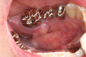歯肉膿瘍（慢性化膿性炎）
