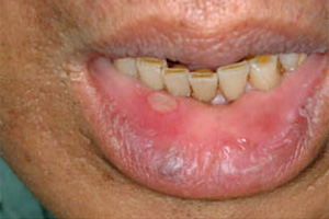 ステージ3の口唇がん