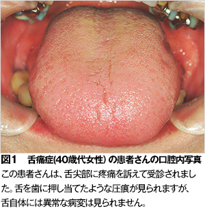 舌痛症 歯とお口のことなら何でもわかる テーマパーク80