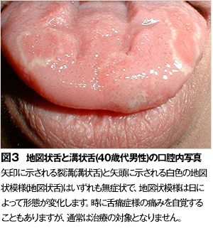 痛い 舌 【写真で見る】舌の病気・できもの辞典