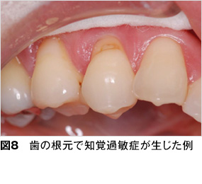 し 歯 みる 水