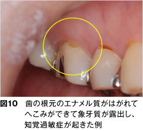 知覚過敏 歯とお口のことなら何でもわかる テーマパーク80