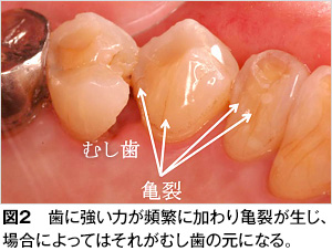 原因 歯ぎしり