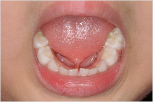 shita img 01 https://sasebo.tv/category/orthodontics/%e8%88%8c%e5%b0%8f%e5%b8%af/