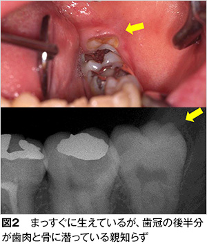 いつまで 痛み 親知らず 抜歯 親知らずの抜歯後、口が開かない・・・いつまで？