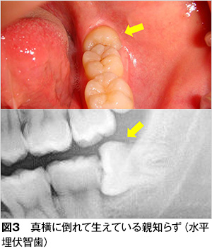 親知らず 歯とお口のことなら何でもわかる テーマパーク80