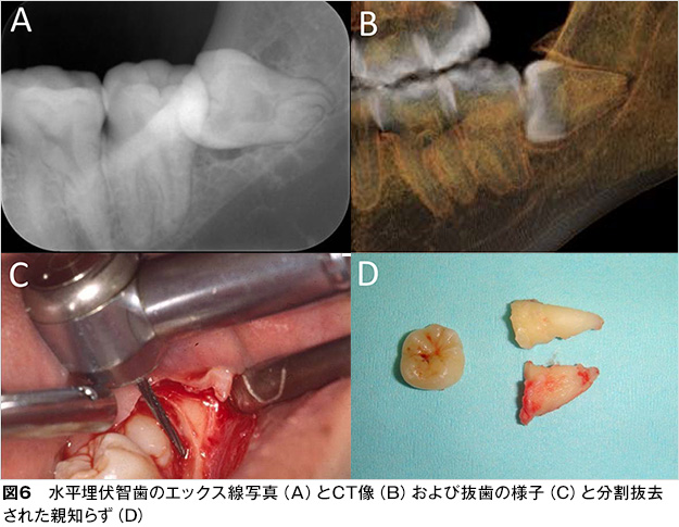 親知らず 歯とお口のことなら何でもわかる テーマパーク80