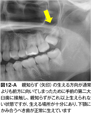 親知らず 横向き