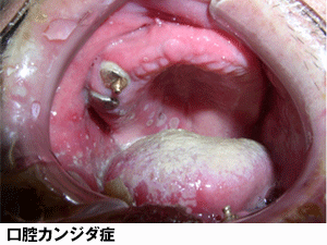 歯茎の腫れ 抗生物質 フロモックス 市販